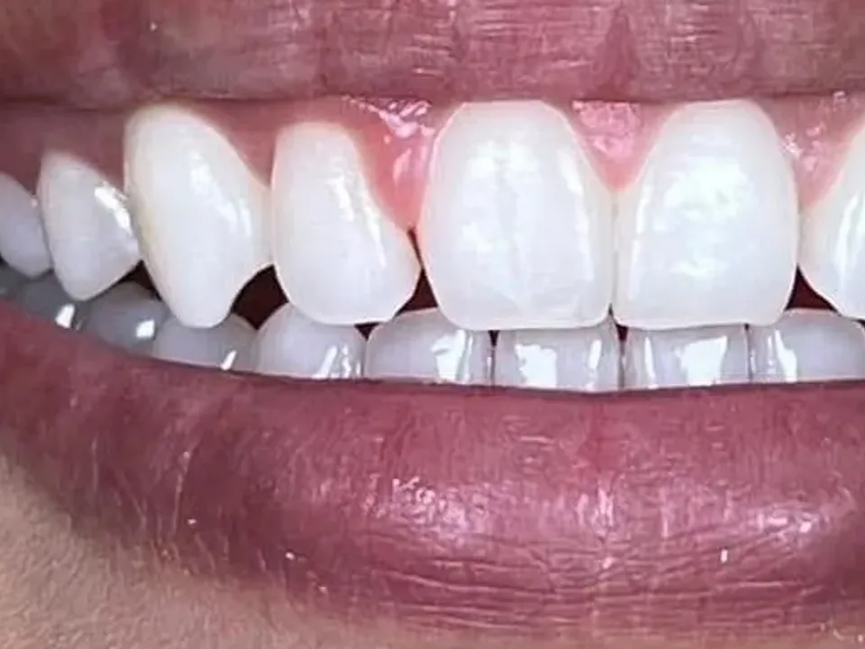จัดฟันใส Invisalign หลังรักษา